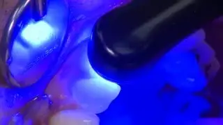 ULTRADENT PRODUCTS, Inc - PermaFlo&reg; DC (Crown Cementation Using)