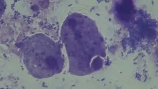 Venerology. Trichomoniasis in mulieribus.