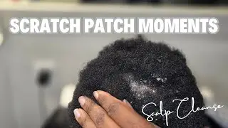 Dandruff Scratch Patch Moments