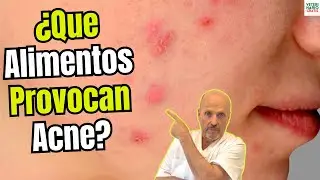 🍫🥛&iquest;QUE ALIMENTOS PROVOCAN MAS ACNE? Y OTRAS CAUSAS RELACIONADAS EL ACNE🍫🥛