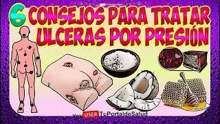 6 Consejos Para Tratar las Ulceras por Presion | Escaras llagas Remedios