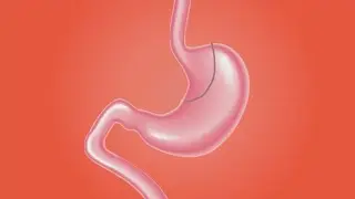 HealthWatch: Gastric Bypass vs Gastric Sleeve for Weight Loss