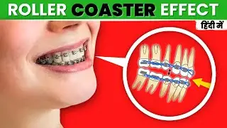 What is Roller Coaster Effect in Orthodontics? #orthodontics