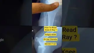How To Read Knee X Ray ? Valgus Knee..Dr Sai Chandra..9573517107