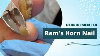 Debridement of Ram's Horn Nails #toenailfungus #toenailfungustreatment #toenail_removal