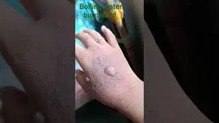 Boiling water burn hand #share #burnhand #share #hand