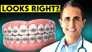 Why &ldquo;Fast Braces&rdquo; Often Don&rsquo;t End How Patients Expect