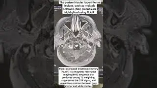 FLAIR MRI: The Sequences that Save Lives