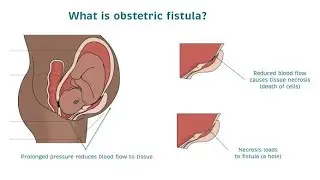 Obstetric Fistula ; devastating childbirth injuries, abnormal openings