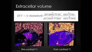 ShMOLLI T1 mapping of Cardiac MRI for myocardial tissue characterization 惲純和