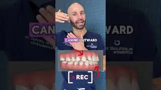 Adult crossbite fix with Invisalign. ￼