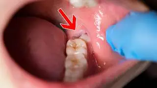 Why Wisdom Teeth Cause So Many Problems (and When to Remove Them)