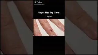 Finger Healing Time Lapse #science #biology #shorts
