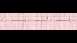 Never Forget, Or Mix Up Heart Blocks Again
