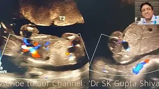 Twin Growth Discordance. गर्भ में जुड़वा बच्चो में एक बहुत कामजोर शिशु, क्यो?