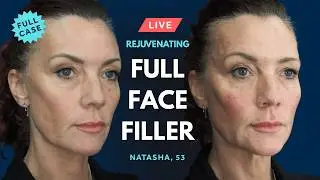 LIVE Multi-Area Filler Treatments 💎 GEM&copy; Clinic Facial Rejuvenation inc. Temple & Midface Fillers