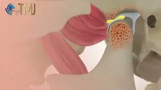 Jaw clicking  (disc displacement with reduction)