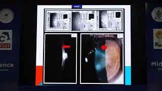 AIOCMTC2 2023 GP28 topic Dr Charuta Puranik Progressive Endothelial cell loss in Keratoconus post CX