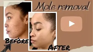 Mole Removal Vlog |start to finish| What to expect DPN removal/ Before&After care tips