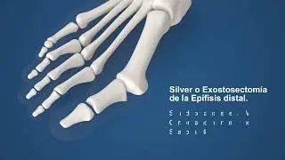 Animaci&oacute;n Osteotom&iacute;a Wilson Quiros