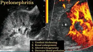 Sonographic Appearances of Renal Infections || Radiology cases tutorial