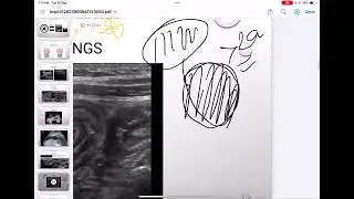 Pediatric Ultrasound ( intussusception, IHPS, Acute appendicitis )