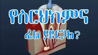የጥርስ ስር ህክምና ፌል/Fail  ሊያደርግ ይችላል