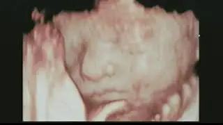 5d ultrasound from private sperm donation by Joe Donor