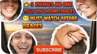 Everything You Need To Know About BRACES 🦷 | Cost? | Duration | Restrictions? ❓