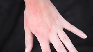 Rash - SFX makeup Tutorial