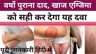 दाद,खाज,खुजली में चमत्कारी है यह दवा | Medicine For Scabies | दाद को जड़ से खत्म करने वाली दवा
