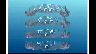 Invisalign  how does it work, Invisalign dentist Palm Beach Gardens FL Dr. Gary Kijanka