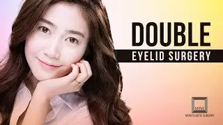 Get perfect eye? DOUBLE EYELID SURGERY RECOVERY VLOG.