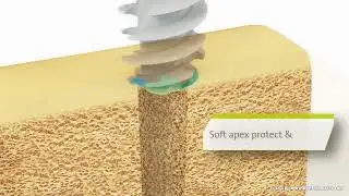Straumann&reg; ImmediaXy