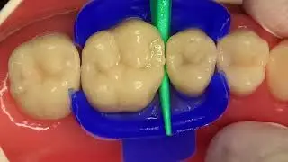 Icon Proximal by DMG: Case by Prof. Leandro Hilgert