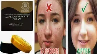 Dr James Acne and freckle cream natural herbs || Anne and Freckle Cream,uses,Benefits Price Reviews