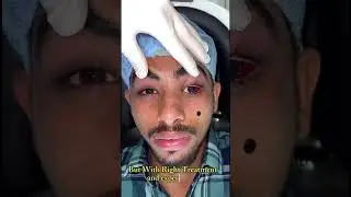 Squint Cross Eye Can&rsquo;t Be Fixed by Drops or Tricks  Here&rsquo;s the Truth