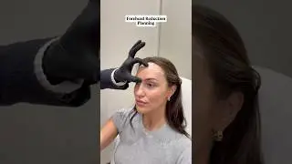 Forehead Reduction Planning 💆🏻&zwj;♀️ Dr. Ahmet Dilber ✨ #foreheadreduction #hairlinelowering