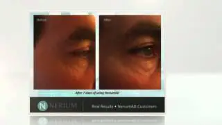 Non Surgical Facelift | NeriumAD | Before and After Views