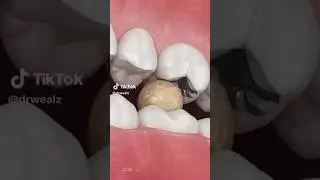 What happens when a tooth cracks.