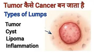 Human Body Series Ep-2 Types of Lumps Tumor Lipoma Cyst Inflammation in Hindi