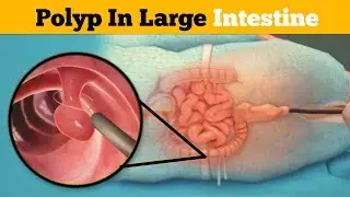 Colon Polypectomy | Removal Of Polyp From Large Intestine Procedure | 3D Animated (Urdu/Hindi)