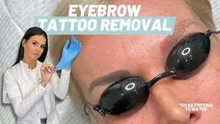 Eyebrow laser tattoo removal - with the pico laser l PMU REMOVAL