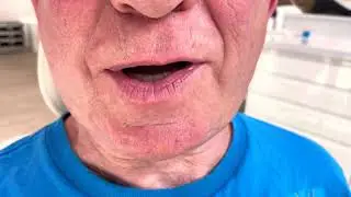 Raising the bite of teeth