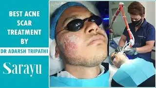Best Acne Scar Treatment in Delhi | Facial Scar Removal Treatment Full Procedure Video