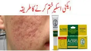 HOW TO REMOVE ACNE SCARS\\ Dark spots  Removal Treatments review in urdu