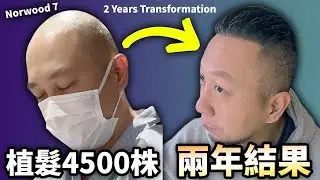 在日香港人，日本植髮4500株兩年結果！費用如何？後頭部狀況公開㊙
