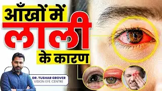 आंखों में लाली के कारण | Causes of Redness in Eyes