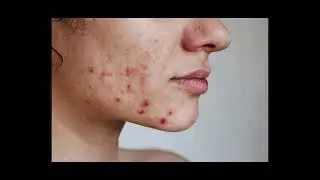 Say Goodbye to Acne Naturally! #clearskin #acnesolutions
