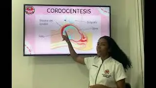 Cordocentesis